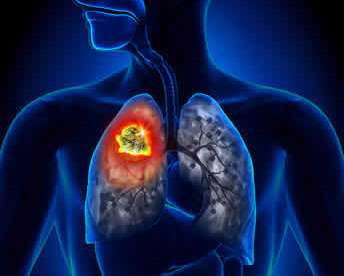 Studio internazionale conferma legame tra inquinamento atmosferico e disturbi respiratori